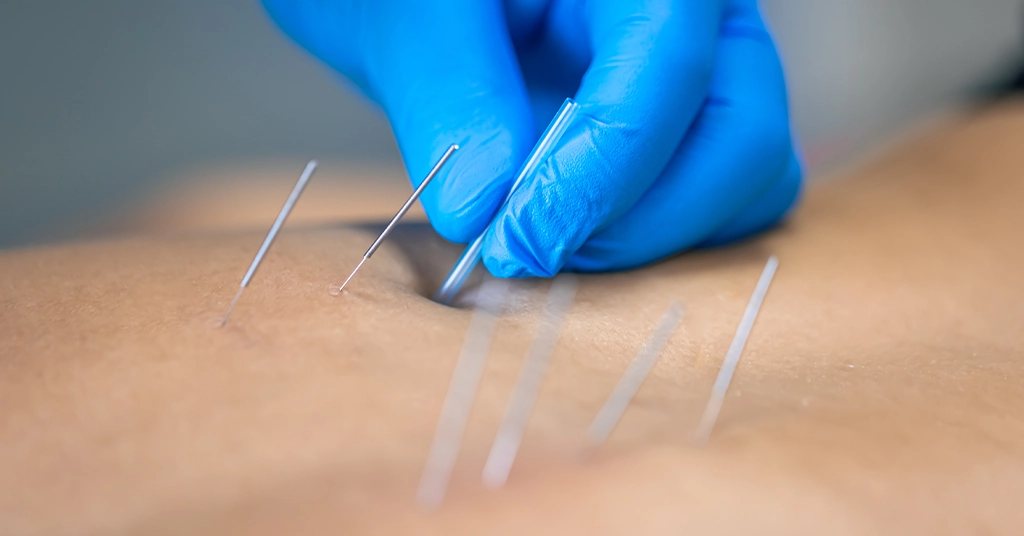 طب سوزنی بعد از ترک اعتیاد